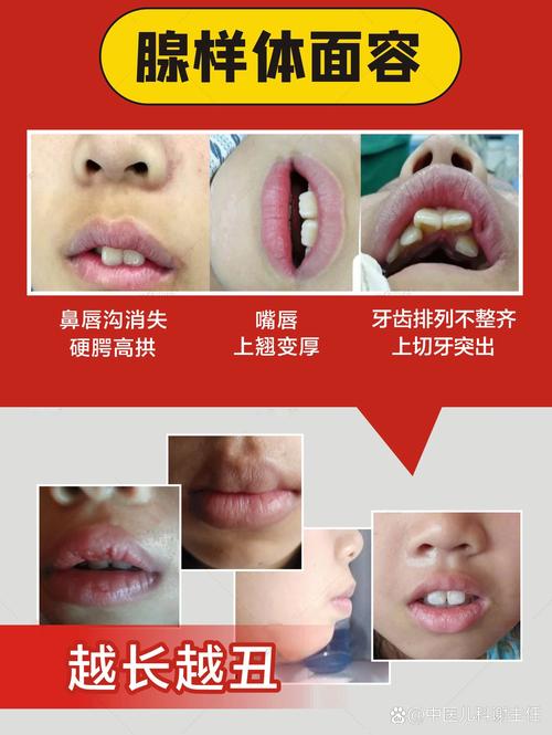 2025新澳门天天开好彩.和挖鼻孔满脸肿胀变形与挖鼻孔满脸肿胀变形怎么办